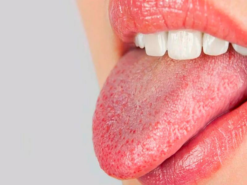 Сухость слизистой во рту Сушняк во рту